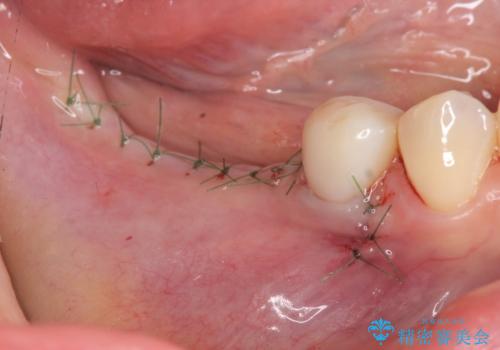 インプラント治療による咬合機能回復の治療中