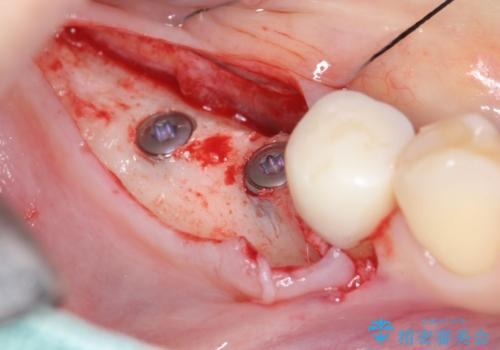 インプラント治療による咬合機能回復の治療中
