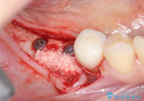 インプラント治療による咬合機能回復の治療中