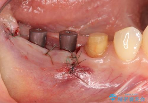 インプラント治療による咬合機能回復の治療中