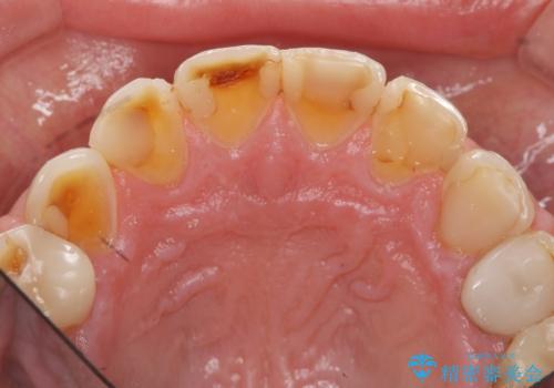 歯ぎしりですり減った 前歯の見た目を回復したいの治療前