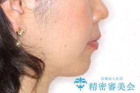 矮小歯を綺麗な歯に。矯正とセラミックの総合治療の治療前(顔貌)