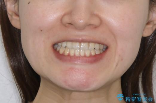 歯がないところに歯をつくる:矯正とセラミックの合わせ技で審美的な口元をの治療後（顔貌）
