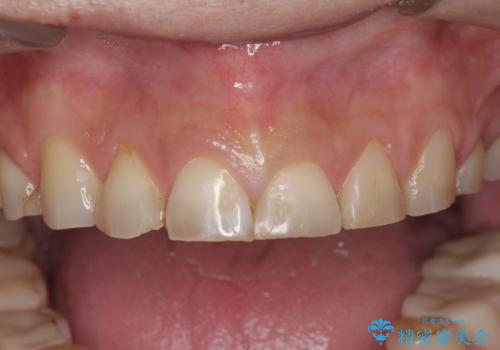 歯ぎしりですり減った 前歯の見た目を回復したいの治療前