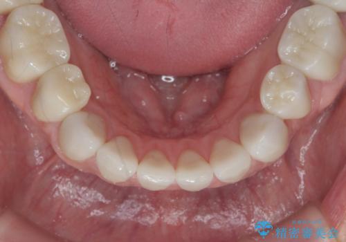 歯ぎしりですり減った 前歯の見た目を回復したいの治療後