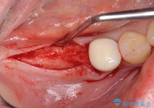 インプラント治療による咬合機能回復の治療中