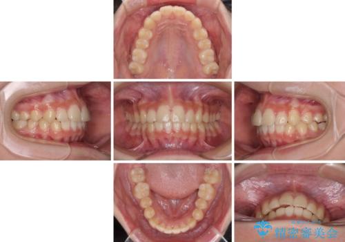 下の前歯が隠れてしまうほど深い咬み合わせ 高校生のインビザライン矯正治療の治療中