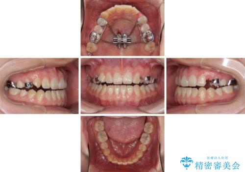 受け口で開咬を急速拡大装置とインビザラインで改善　欠損部分はインプラントにて補綴治療の治療中