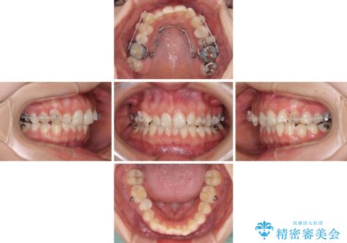 インビザライン単独では困難 補助装置を併用した矯正治療の治療中