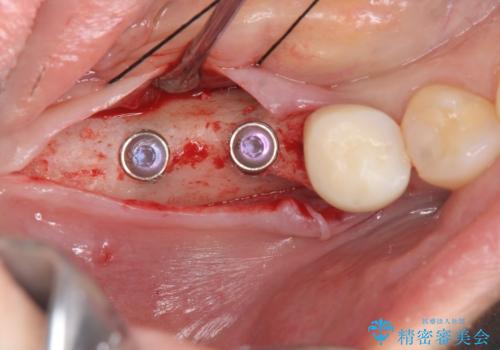 インプラント治療による咬合機能回復の治療中