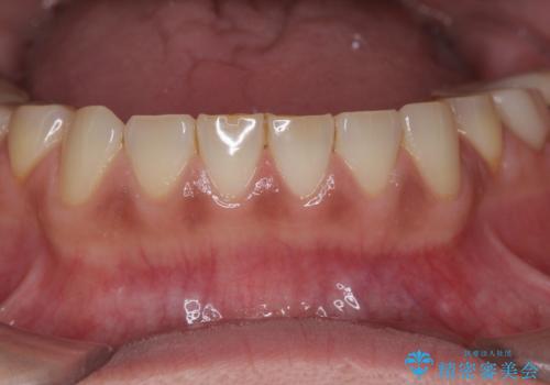 歯ぎしりですり減った 前歯の見た目を回復したいの治療前