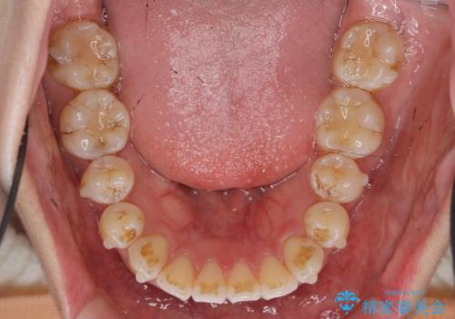 数ヶ月で、わずかな歯並びの修正に対応するインビザラインライト治療の治療中