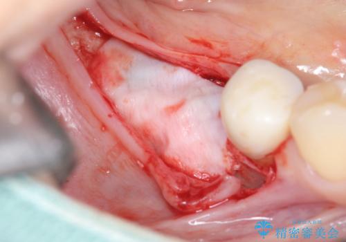 インプラント治療による咬合機能回復の治療中