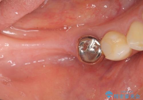 インプラント治療による咬合機能回復の治療前