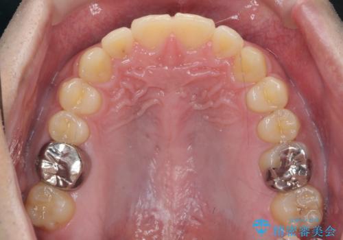 インビザラインで行うカモフラージュ矯正の治療後