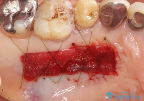 薄い骨幅 骨造成 歯肉移植を併用したインプラント治療の治療中