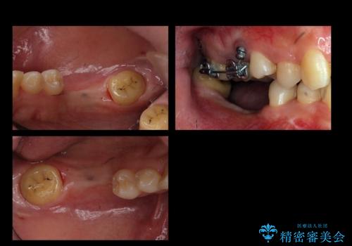 虫歯を放置 しっかり治療したい。 抜歯してインプラント治療の治療中