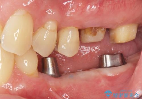 臼歯部インプラント・再補綴の治療中