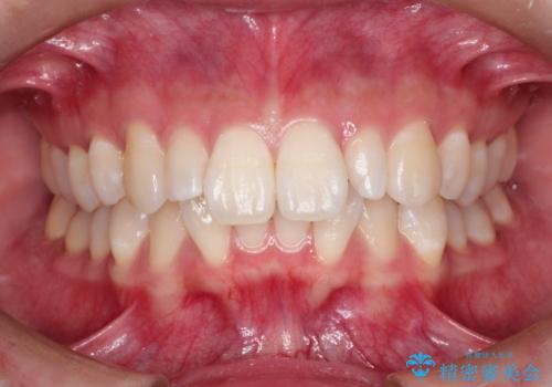 ワイヤー矯正とオールセラミックの組み合わせ治療の治療前