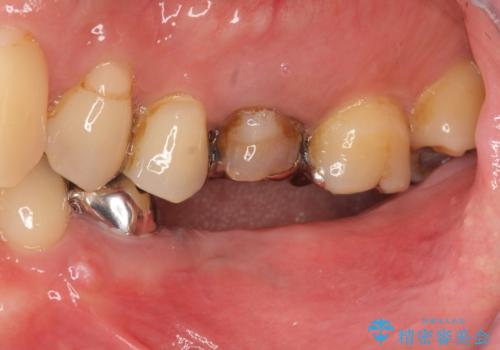 臼歯部インプラント・再補綴の症例 治療前
