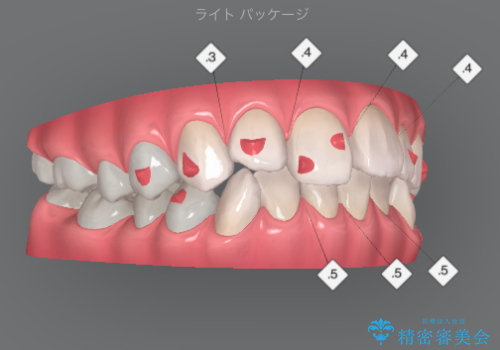 インビザラインライトで行う短期マウスピース矯正治療