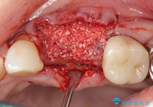 骨の造成を伴うインプラント治療の治療前