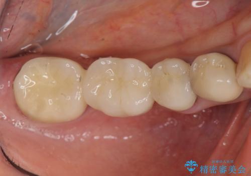 臼歯部メタルフリー再補綴の治療前