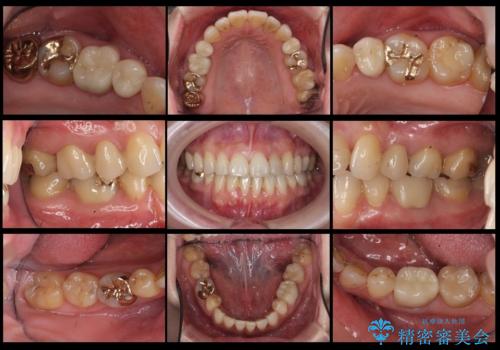 全体的な虫歯治療 の治療後
