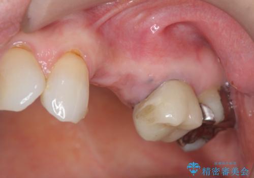 骨の造成を伴うインプラント治療の治療前