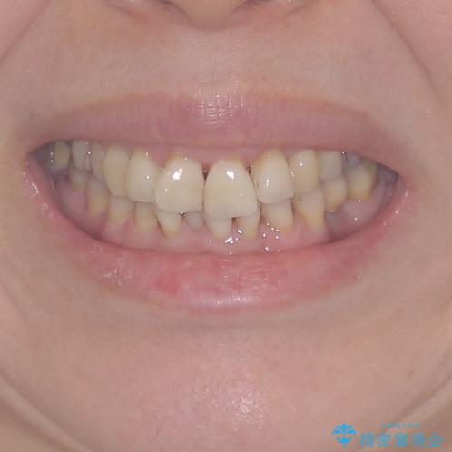 口元の出っ張りとデコボコを改善したいの治療前(顔貌)