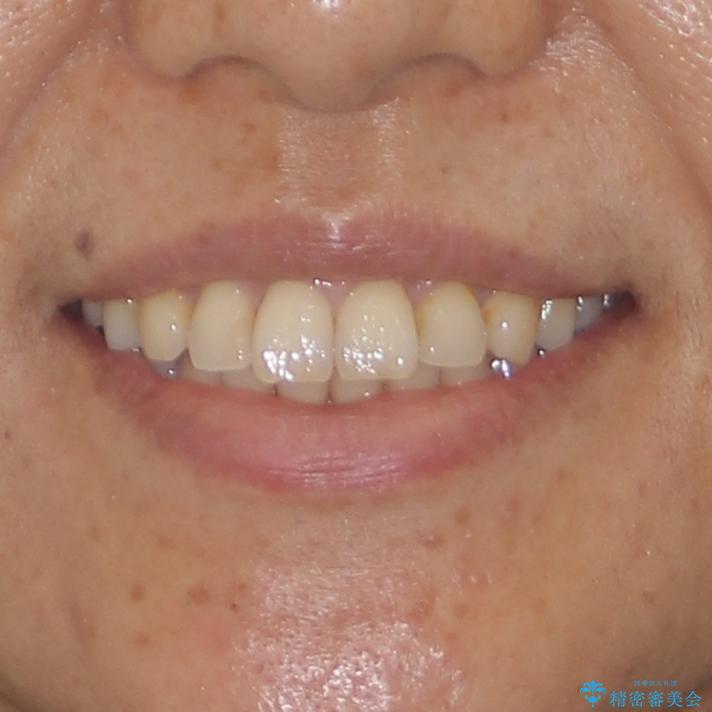 痛む奥歯と矯正の後戻り インビザライン・ライトとセラミック治療の治療前(顔貌)