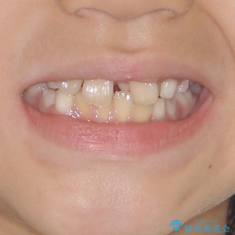 過剰歯を抜歯して前歯を排列　インビザライン・ファーストによる小学生のⅠ期治療の治療前（顔貌）