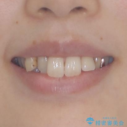 短期間での治療 急速拡大装置を併用したワイヤー装置による矯正治療の治療前(顔貌)