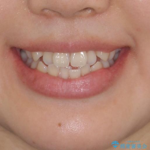 ワイヤー矯正を併用し、リスクを回避しながらのインビザライン矯正治療の治療前(顔貌)