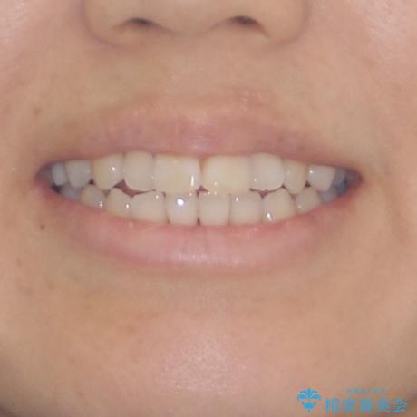 気になる前歯をインビザライン・ライトで　矯正治療後には銀歯をセラミックにの治療前（顔貌）