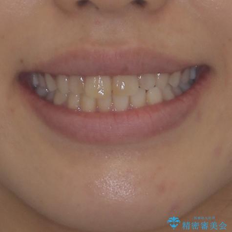 気になる前歯を治したい インビザラインで気づかれずに矯正治療の治療前(顔貌)