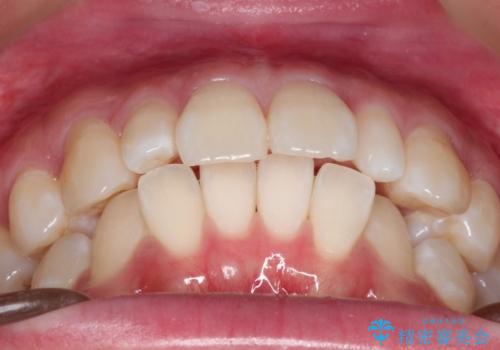 ワイヤー矯正とオールセラミックの組み合わせ治療の治療前