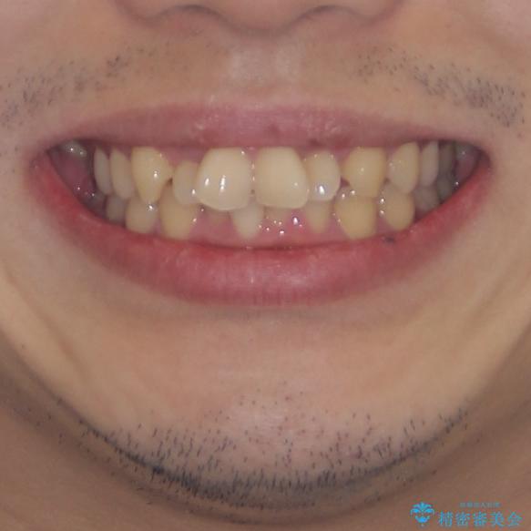 強い咬み込みですり減った前歯　デコボコを抜歯矯正で整えるの治療前（顔貌）