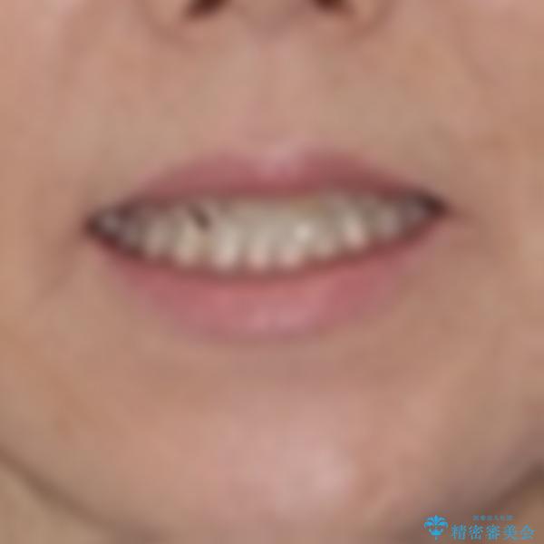 前歯のスペースが気になる　インビザラインによる矯正治療の治療前（顔貌）