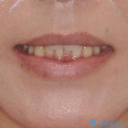 沖縄から飛行機で通院 インビザラインによる矯正治療の治療前(顔貌)