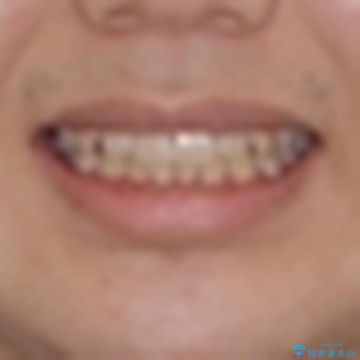 しっかり使って短期間で治療 インビザラインによる叢生解消の治療前(顔貌)