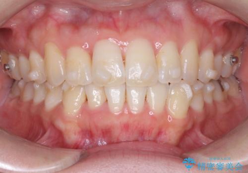 【インビザライン】前歯の凸凹をなおしたいの治療中