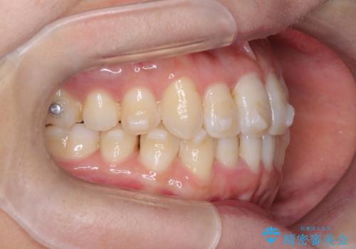 【インビザライン】前歯の凸凹をなおしたいの治療中