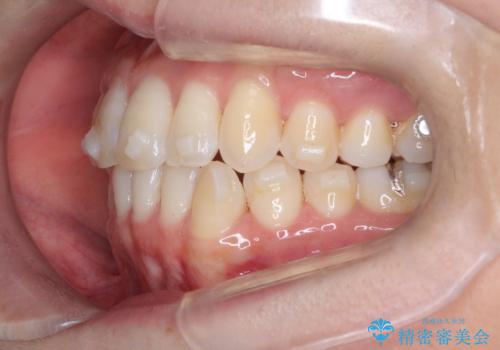【インビザライン】前歯の凸凹をなおしたいの治療中