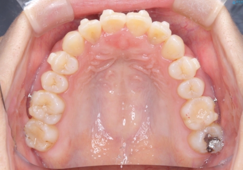 【インビザライン】前歯の凸凹をなおしたいの治療中