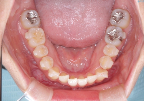 【インビザライン】前歯の凸凹をなおしたいの治療中