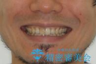 【前歯の隙間】インビザラインですきっ歯の矯正治療の治療後（顔貌）
