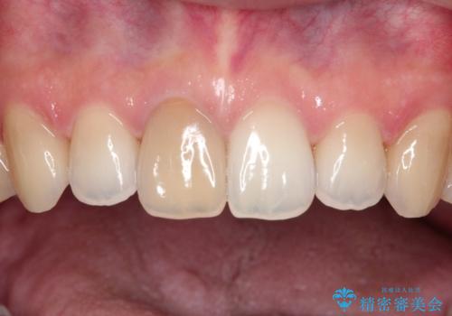 【前歯の被せ物】オールセラミッククラウン(エクセレント)の治療前