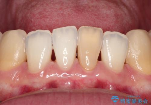 下顎前歯のセラミッククラウンの症例 治療前