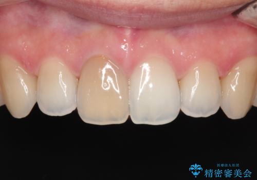【前歯の被せ物】オールセラミッククラウン(エクセレント)の治療前